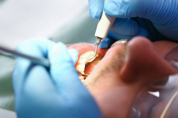 Best Emergency Wisdom Teeth Removal in Merrick, NY