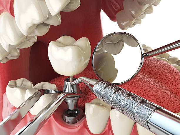 Best Emergency Root Canal Treatment in Merrick, NY